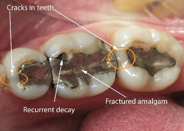 708_cracks in teeth fractured amalgam recurrent decay.jpg