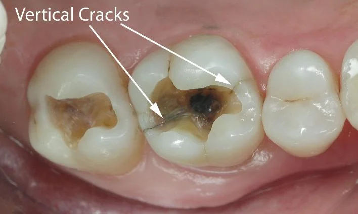 708_vertical cracks.jpg