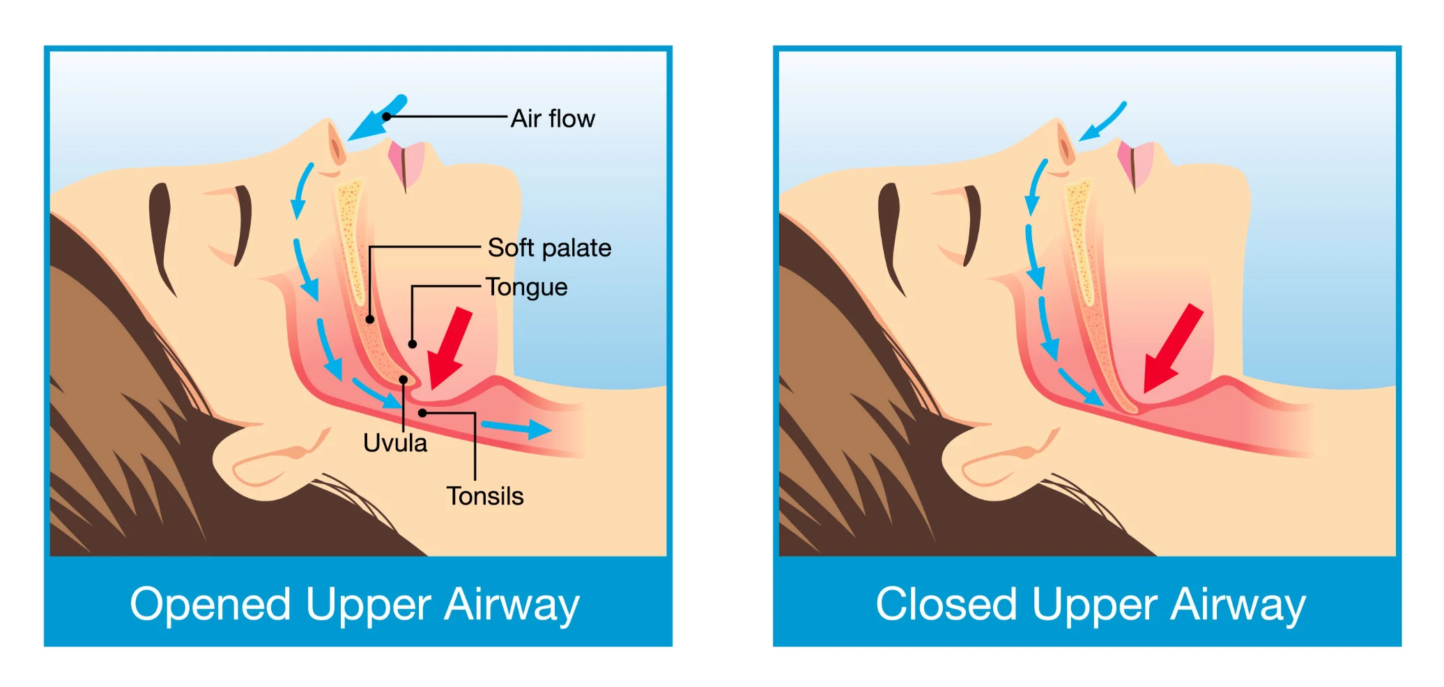 snoring and SLEEP APNEA.jpg