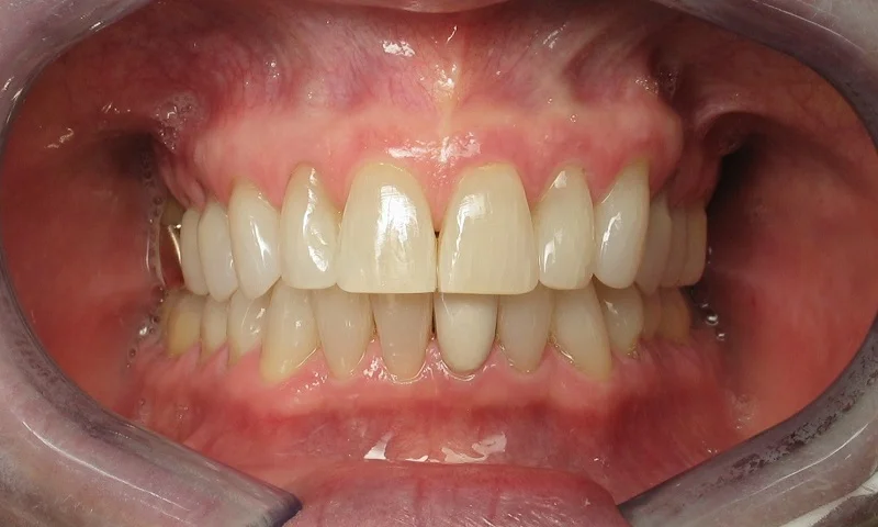 Adult Braces-After-8 months of braces and teeth whitening
