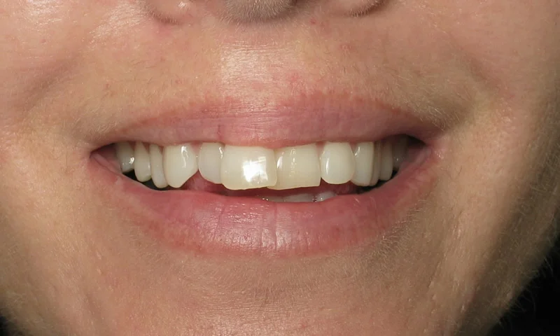 Adult Braces-Before-Crooked and crowed upper and lower teeth