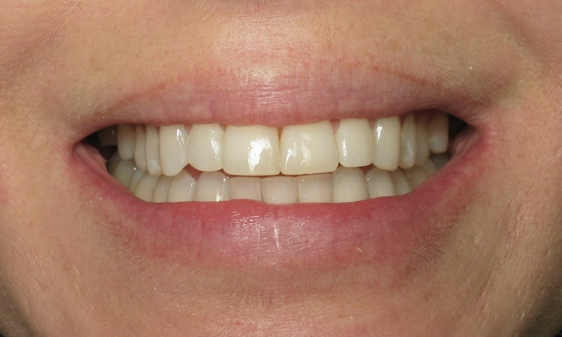 Adult Braces-After-8 months of braces with reshaping