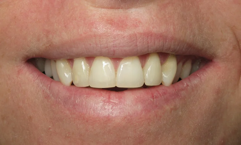 Adult Braces-After-5 months of ortho with reshaping