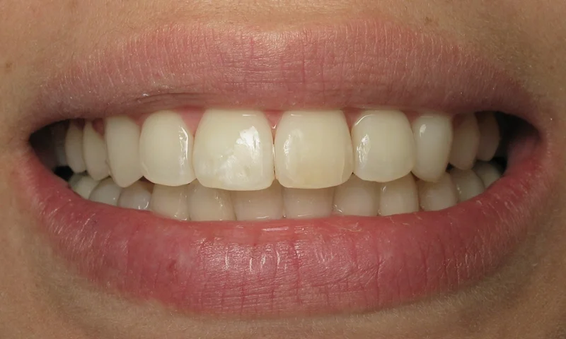 Adult Braces-After-Treatment time 6 months
