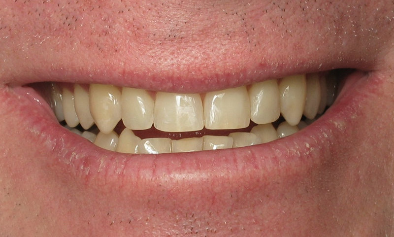 Adult Braces-After-5 Months Braces on upper teeth with reshaping