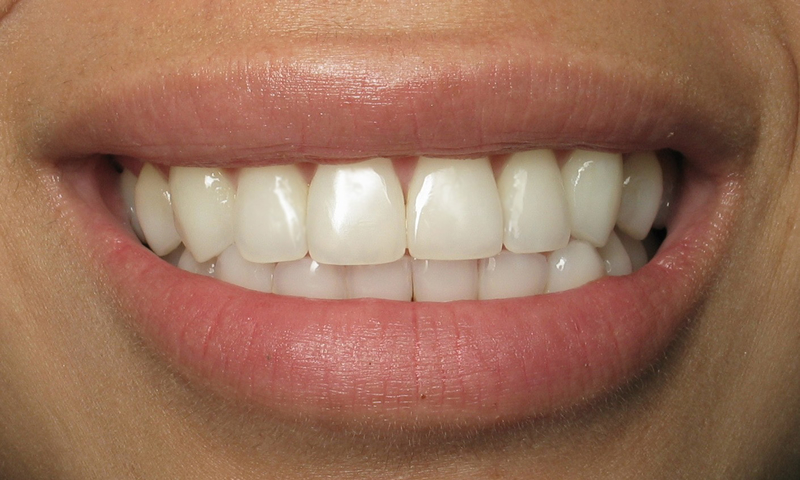 Adult Braces-After-7 months braces with bonded retainers