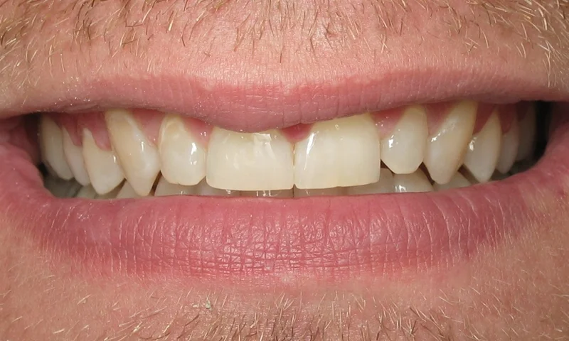 Adult Braces-After-Treatment time 9 months