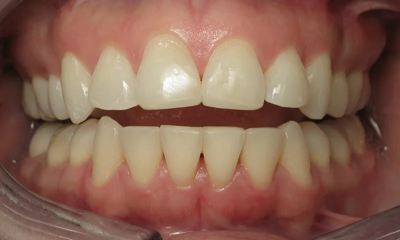 Adult Braces-3 months of ortho on lower with bonding on the upper incisors