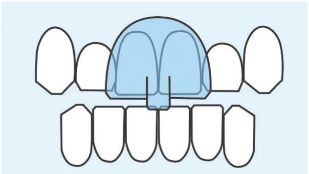 The NTI in place. Only a small point on the front teeth is able to contact.