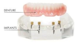 Overdenture example
