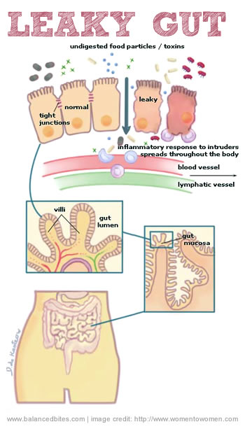leakyGut.jpg