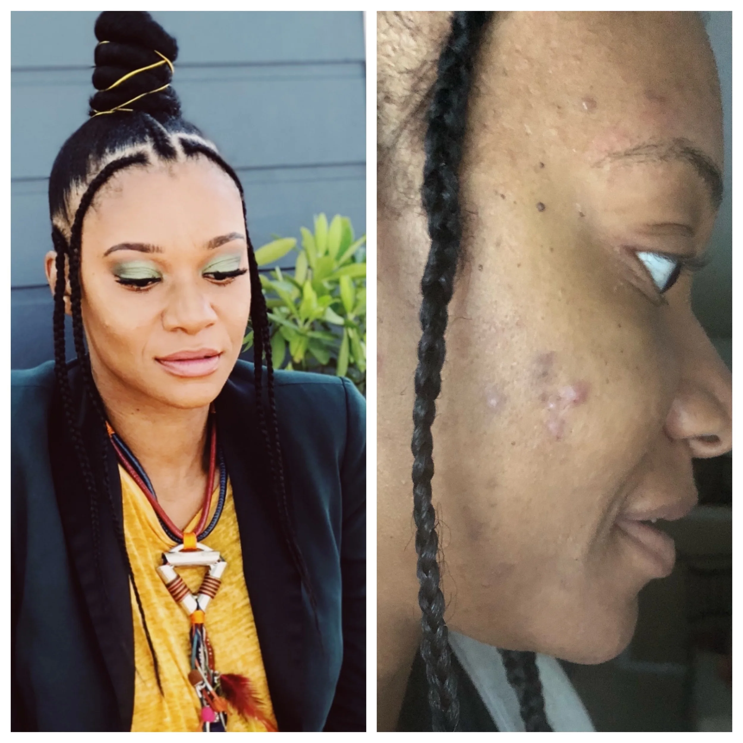 August 2018: I did the best that I could with filters and makeup but I needed a real solution!