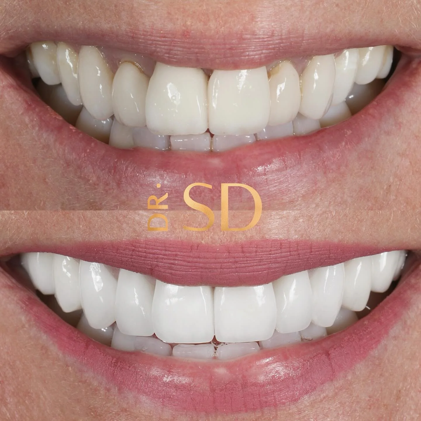 Getting to the root of the issue porcelain veneers or composite