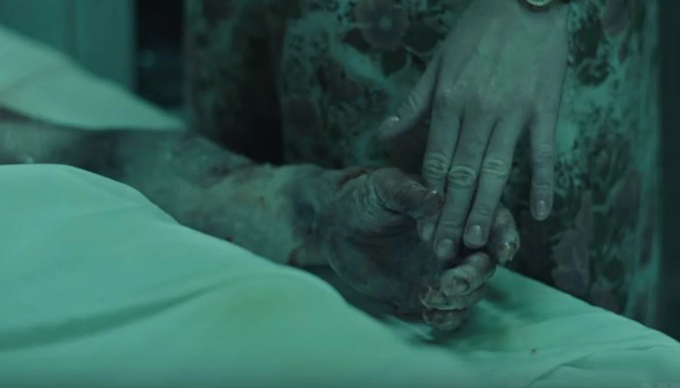 Radiation eating away at Vasily’s hand.