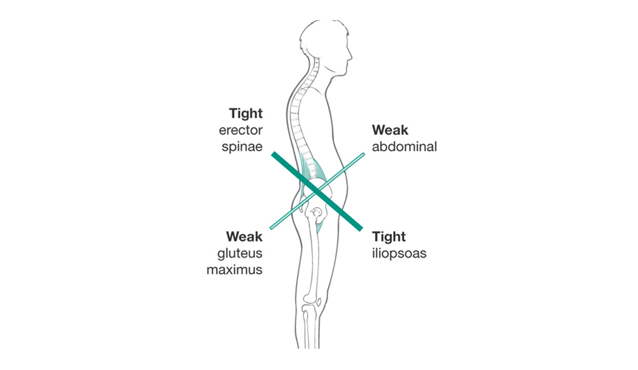 Lower-Cross-Syndrome-Posture-Pain-Minnesota-Movement-Chiropractic-Excelsior.jpg