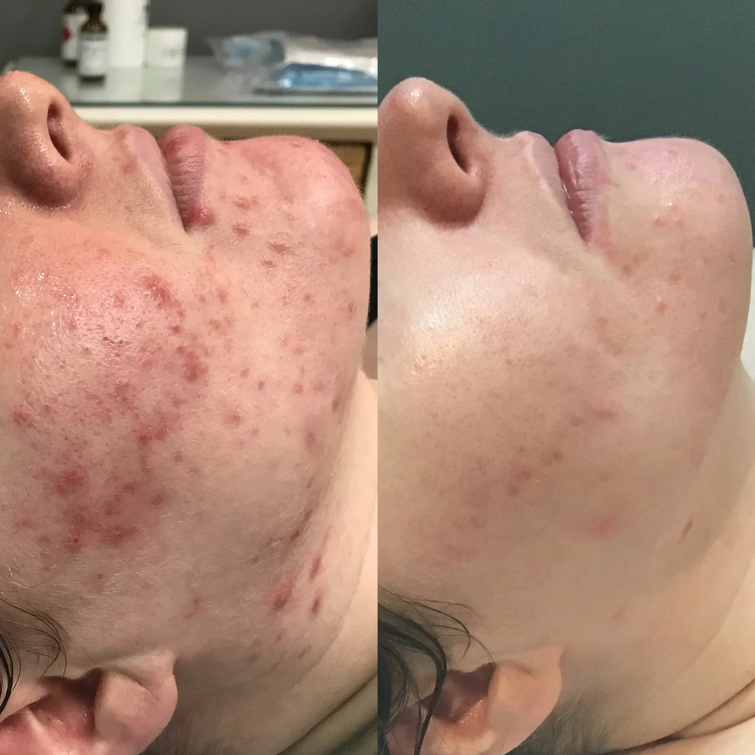 Medifacial, Enzyme Therapy, Skin Needling