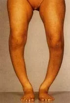 rickets2.jpg