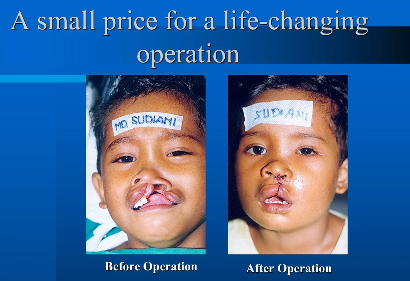 Cleft Lip and Palate.jpg