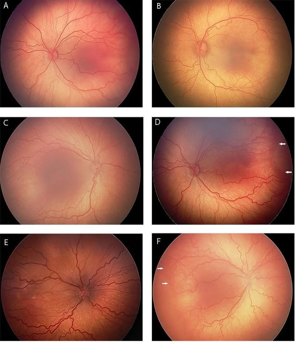 Icrop Retinopathy of Prematurity (Coffee Table Book) — Ophthalmology Review