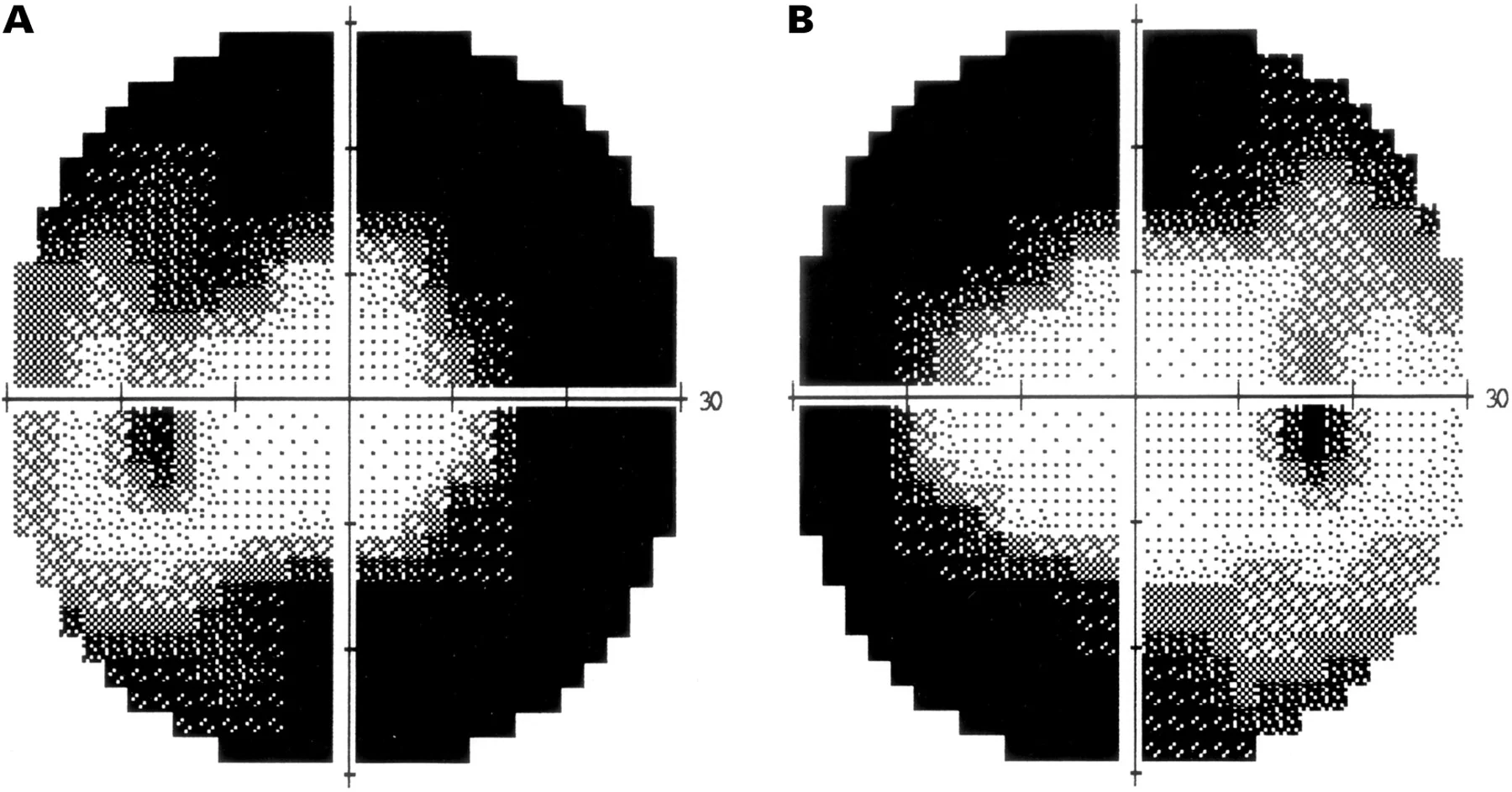 Visual field loss in vigabatrin demonstrating bilateral tunnel visual fields. ( Ravindran et al )