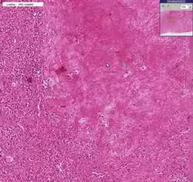 Histopathology of syphilitic gumma. Note the area of necrotic tissue (top right) surrounded by lymphocytic inflammation (small round blue cells in the bottom left). Image credit: YouTube .