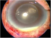 endophthalmitis.jpg
