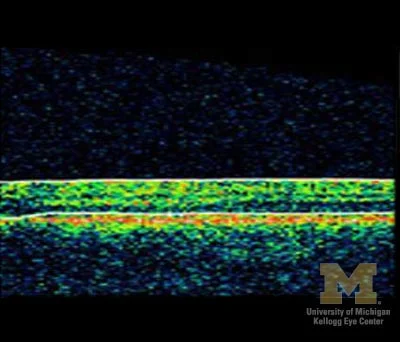 OCT showing foveal hypoplasia. Aniridia is on the differential diagnosis for foveal hypoplasia. Image credit: University of Michigan .
