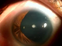 Aniridia 4.jpg
