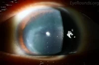 Aniridia 5.jpg