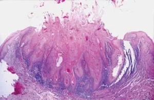 Histopathology of a keratoacanthoma. Note the significant keratin-filled crater (pink in the middle). Image credit: rdhmag.com .