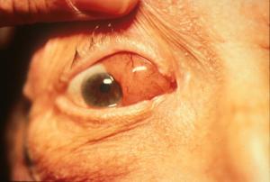 External exam of orbital lymphoma. Note the "salmon patch" appearance of the conjunctiva, which is a key clinical descriptor of orbital lymphoproliferative conditions. Image credit: khanfacial.com