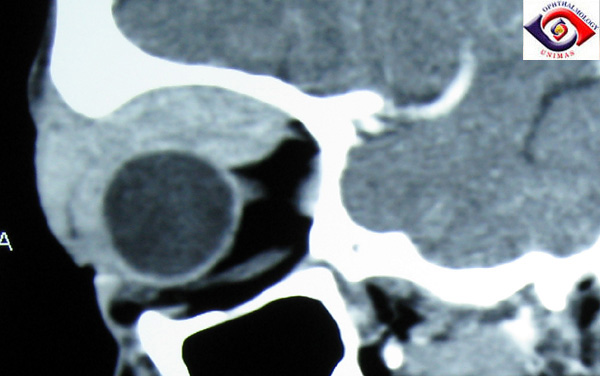 CT coronal scan showing the putty-like molding of orbital lymphoma to ocular structures. Image credit: sarawakeyecare.com .