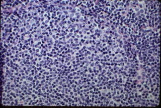 Histopathology of MALT lymphoma. Note the relatively uniform appearance of the blue cells. Image credit: Mission For Vision .