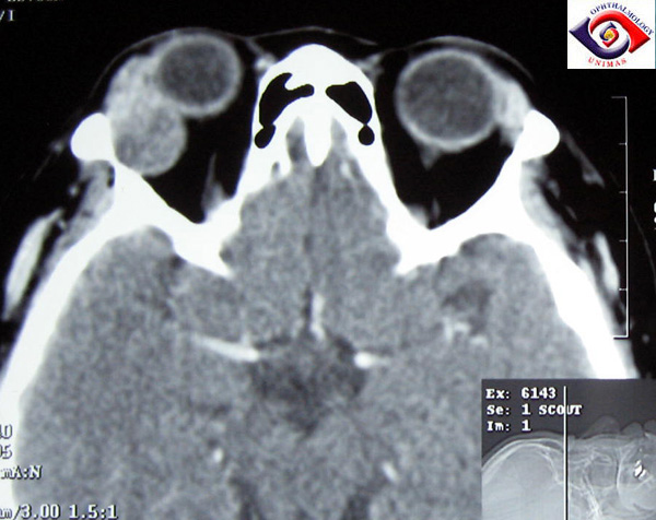 CT axial image of a large lacrimal gland mass. It is well-encapsulated, reflecting the pseudoencapsulation of the tumor. Image credit: sarawakeyecare.com .