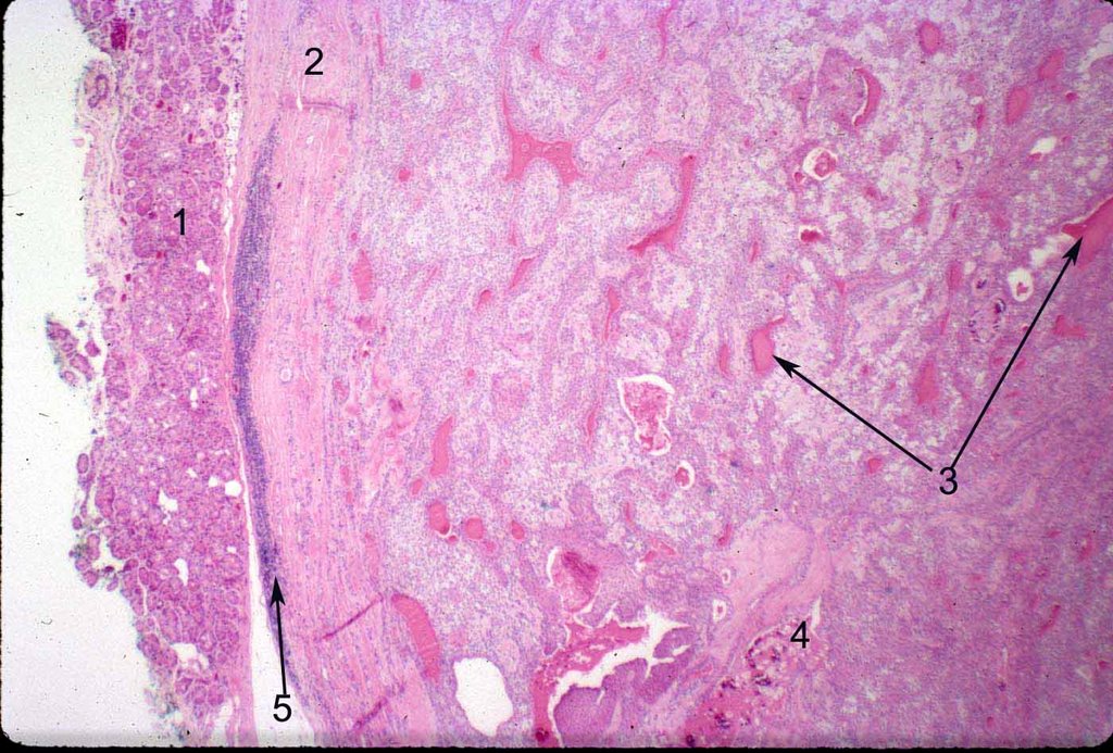 Histopathology of a pleomorphic adenoma. The pseudocapsule is featured on the left (2), pushing the normal lacrimal gland tissue aside (1). Epithelial ducts (3) and calcification may be present (4), and chronic inflammation may be present along the edge of the pseudocapsule (5). Image credit: Mission For Vision .