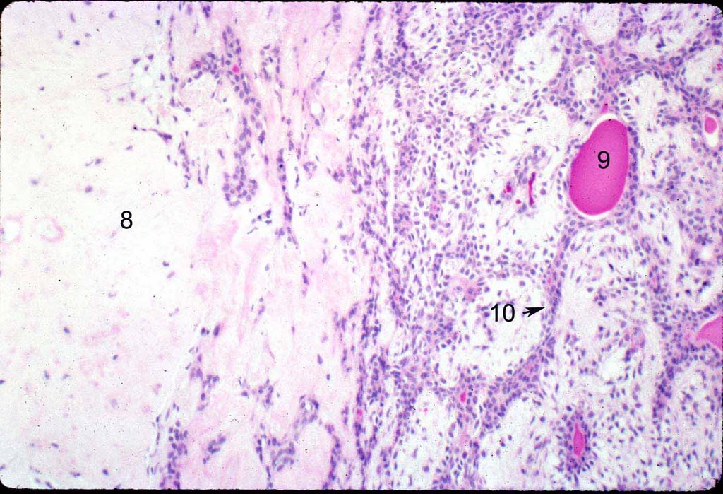 Histopathology of pleomorphic adenoma. There can be cartilaginous material (8) present, as well as hyaline/basement membrane material (9). Epithelial cells form cords and ducts (10). Image credit: Mission For Vision .