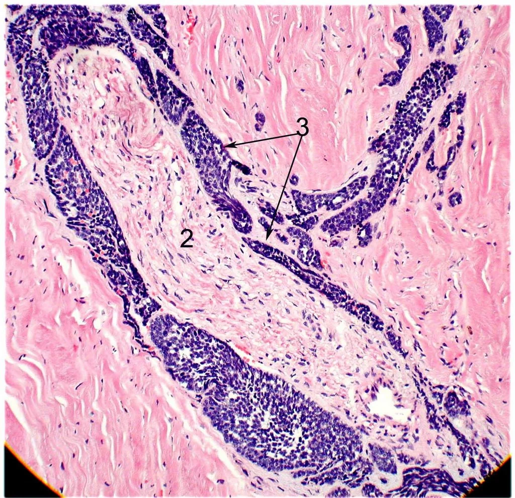 Histopathology of adenoid cystic carcinoma, basaloid type. This slide demonstrates perineural invasion. The blue basaloid cancer cells (3) have surrounded the normal nerve tissue (2). Image credit: Mission For Vision .