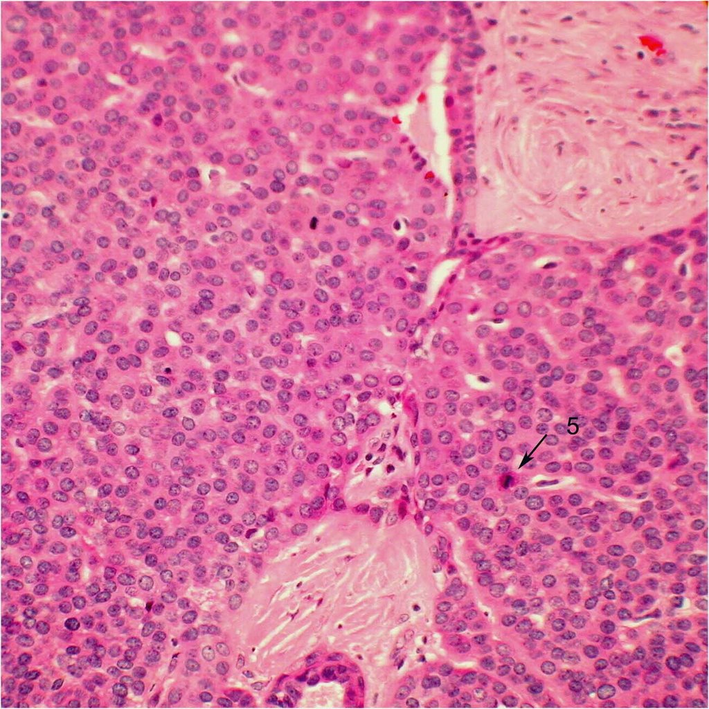 Histopathology of adenoid cystic carcinoma, basaloid type. This slide points out a mitotic figure (5), which suggests aggressive cancerous activity. Image credit: Mission For Vision .