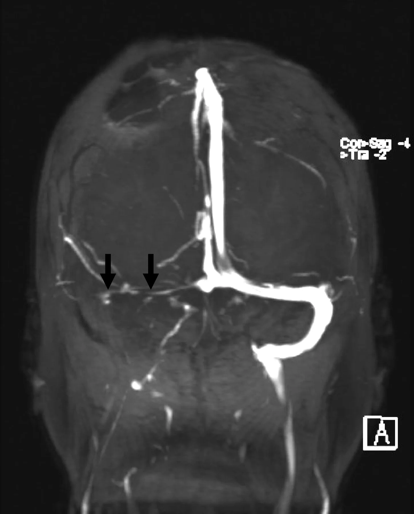 MRV demonstrating thrombosis of the right transverse and sigmoid sinuses (black arrows). Image credit: Saposnik G, Barinagarrementeria F, Brown Jr. RD, et al. Diagnosis and Management of Cerebral Venous Thrombosis: A Statement for Healthcare Professionals From the American Heart Association/American Stroke Association . American Heart Association Stroke Council and the Council on Epidemiology and Prevention. Stroke. 2011;42:1158-1192.