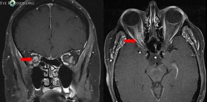MRI of a patient with a right optic nerve sheath meningioma (red arrows). Image from: University of Iowa, EyeRounds.org .