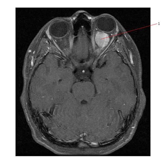 Axial MRI of a left optic nerve glioma (1). Image from: pedsoncologyeducation.com .