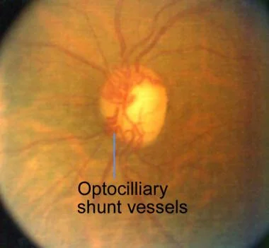 Optociliary shunt vessels in chronic CRVO. Image credit: Medscape .