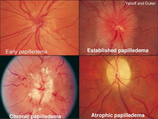 Stages of papilledema. Image credit: slideshare.net .