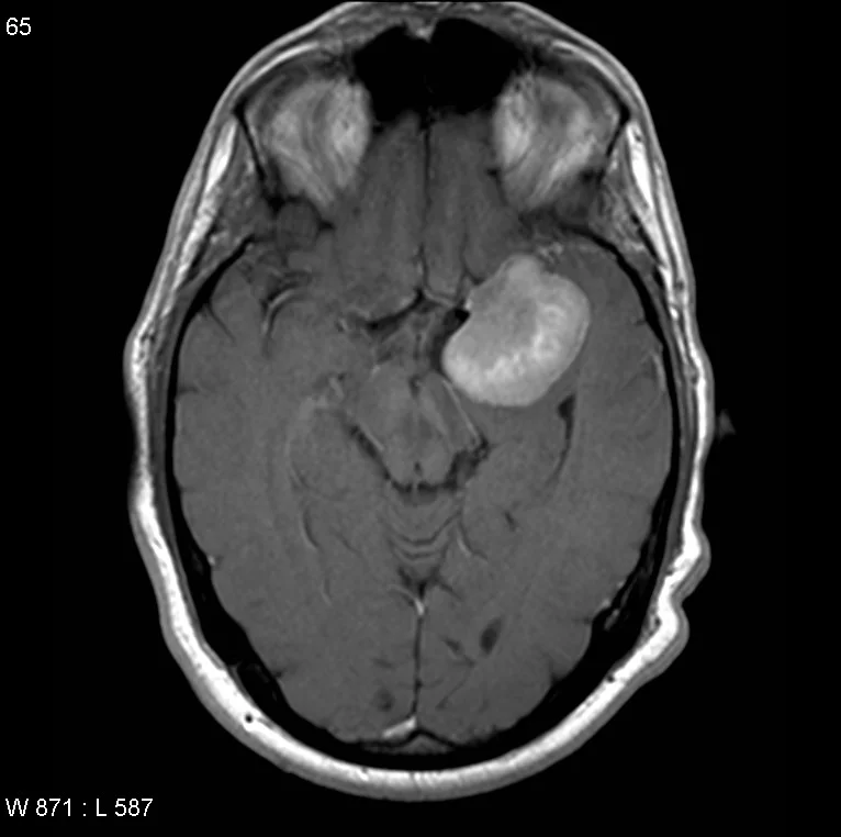 Axial MRI of a left sphenoid wing meningioma. Image credit: Radiopaedia.org .