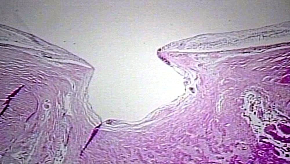 Histopathology of optic nerve hypoplasia. It is described as decreased number of ON axons with normal mesodermal elements and glial supporting tissue. Image credit: pathguy.com .