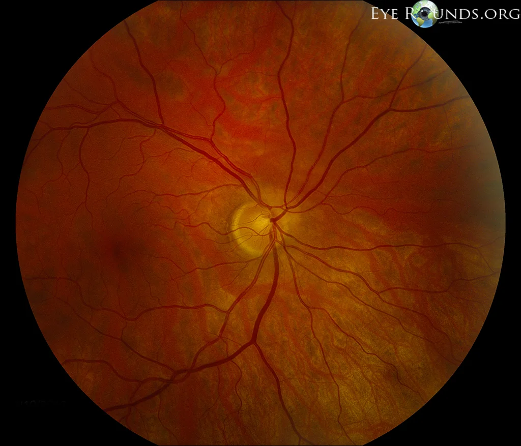 Superior segmental optic nerve hypoplasia. Image credit: University of Iowa, EyeRounds.org .