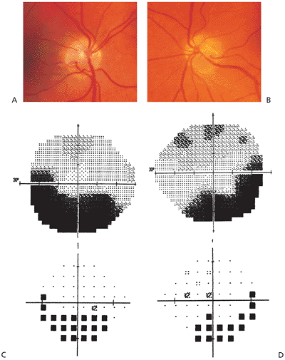 Inferior visual field defects associated with superior segmental optic nerve hypoplasia. Image credit: Fovea.ir .