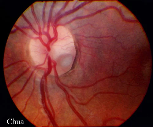 Optic pit. Note the inferotemporal location of the pit. Image credit: mrcophth.com .