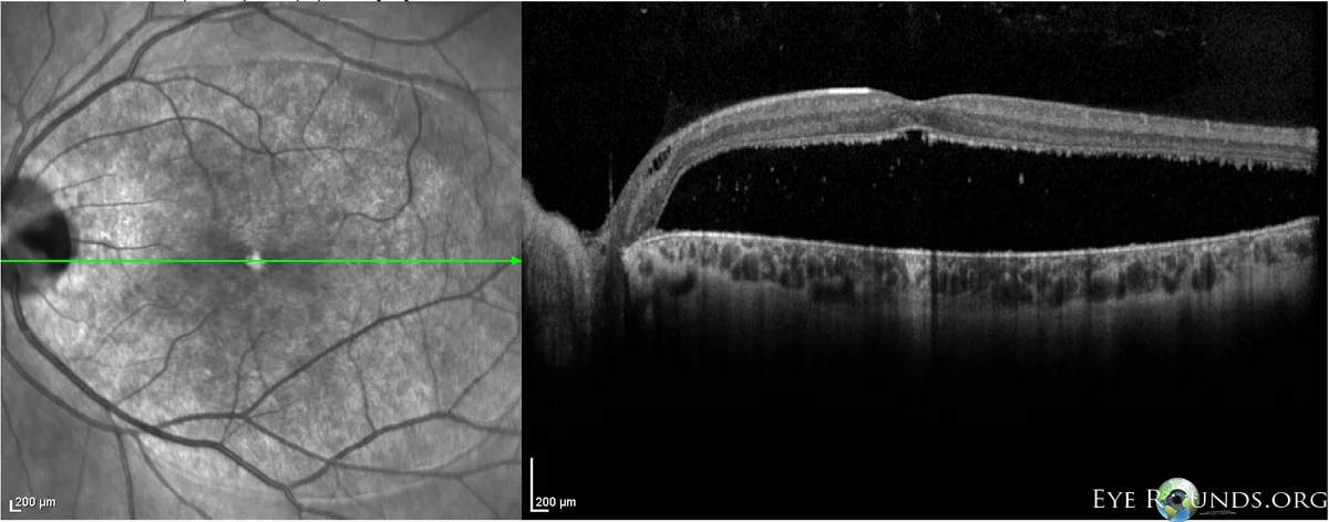 SD-OCT showing a large serous retinal detachment in the case of a optic pit. Image credit: University of Iowa, EyeRounds.org .