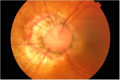 Morning glory disc anomaly. Image credit: Research Gate .
